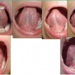 Dính thắng lưỡi ở trẻ em - những điều cần biết - Phần 1