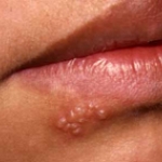 Một số bệnh răng miệng do siêu vi (Virus) 