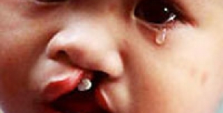 Sứt môi và khe hở hàm ếch : (Cleft lip and cleft palate)