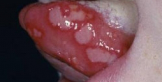 Viêm loét miệng ở trẻ em (Phần 2)
