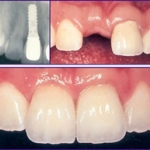 Biện pháp vệ sinh răng miệng cho bệnh nhân mang implant