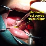 Dính thắng lưỡi ở trẻ em – Những điều cần biết  