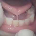 Dính thắng lưỡi là gì ?