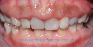 Phục hình răng sứ Cercon Smart – Dentsfly