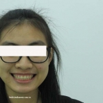 Chữa cười hở nướu