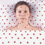 Bệnh Rubella