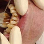 Thuốc lá gây ra bệnh gì?