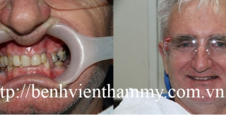 Phục hình răng thẩm mỹ răng nhiễm tertracyclin với Răng sứ Emax Ivoclar vivadent