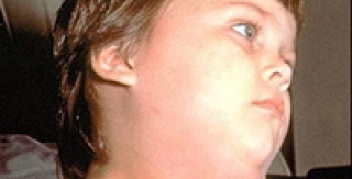 TÌM HIỂU NHANH VỀ BỆNH QUAI BỊ 