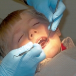 Phương pháp mới chữa răng sữa bị sâu