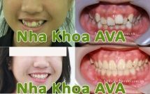 Niềng răng mọc chen chúc ở trẻ em