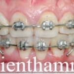 Chỉnh hình răng thẩm mỹ điều trị răng chen chúc với mắc cài kim loại 2