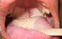 Bệnh do vi nấm ở vùng hàm mặt 