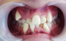 Răng lệch lạc, chữa thế nào?