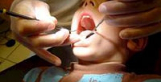 Khám răng, nha sĩ làm rớt kim vào họng bé 4 tuổi