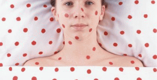 Bệnh Rubella