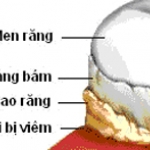 Chế Độ Ăn Và Mảng Bám Vi Khuẩn Gây Bệnh Nha Chu Và Sâu Răng