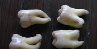 Tại Sao Cần Phải Nhổ Răng Khôn?