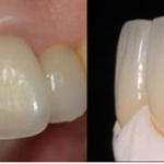 Răng sứ thẩm mỹ