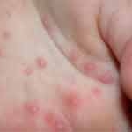 Dinh dưỡng trong bệnh tay chân miệng