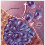Khối u vùng hàm mặt (Oral tumors) 