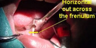 Dính thắng lưỡi ở trẻ em – Những điều cần biết  