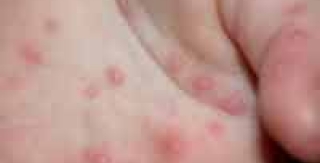 Dinh dưỡng trong bệnh tay chân miệng