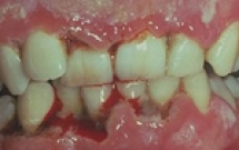 Một số bệnh nhiễm khuẩn ở vùng miệng và vòm hầu 