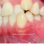 Chỉnh hình răng thẩm mỹ điều trị răng chen chúc - cắn chéo với mắc cài kim loại