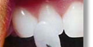 Một số phương pháp làm răng thẩm mỹ 