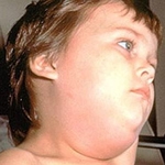 TÌM HIỂU NHANH VỀ BỆNH QUAI BỊ 