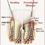 Bệnh nha chu (periodontal disease)