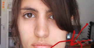 Áp xe vùng dưới hàm