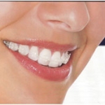 Cười lộ nướu, nguyên nhân và cách khắc phục.