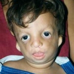 Loạn xương mặt hàm dưới (Mandibulofacial Dysostosis / Treacher Collins syndrome)