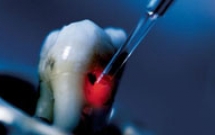Ứng Dụng Của Laser Trong Trám Răng Thẩm Mỹ