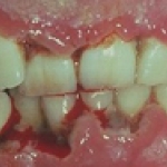 Một số bệnh nhiễm khuẩn ở vùng miệng và vòm hầu 