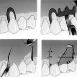 Các phương pháp điều trị co lợi
