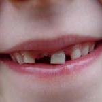 Chăm sóc răng miệng khẩn cấp cho bé