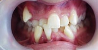 Mối liên quan giữa lệch lạc khớp cắn và dịch vụ Niềng răng?