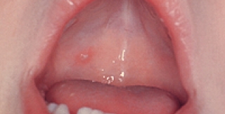 Hãy cẩn thận với vết loét trong miệng