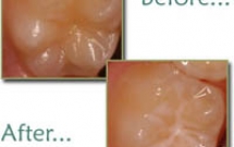 Trám bít hố rãnh bằng sealant