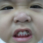 Viêm nướu răng ở trẻ em 