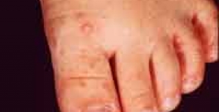 Bệnh tay - chân - miệng, bệnh lý cần quan tâm ở trẻ em