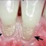 Phòng và điều trị mòn răng
