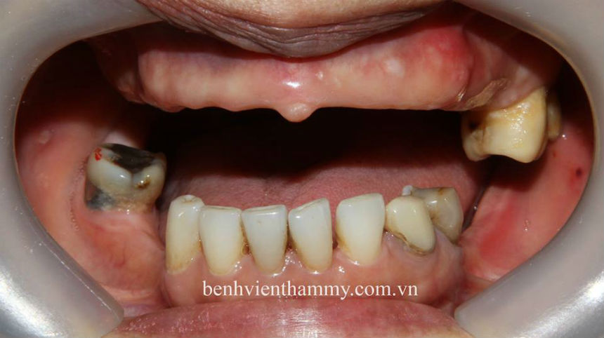 implant toan ham11