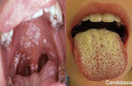 nhiem-nam-candida