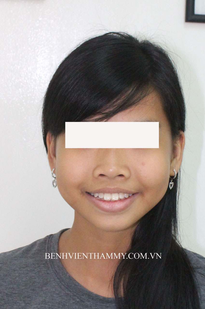 nieng rang ho r2