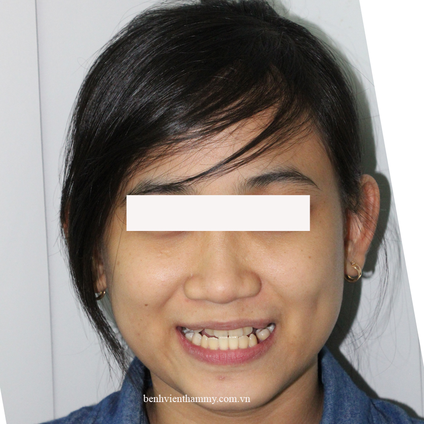 nieng rang mom chen chuc 2