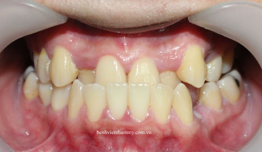 nieng rang mom chen chuc 3